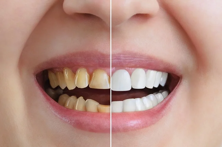 Complete Smile Makeover