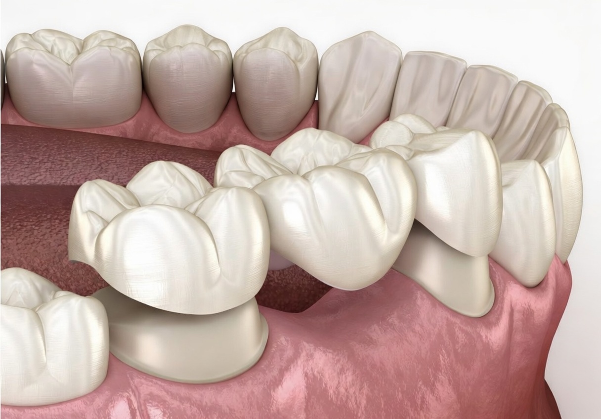 Dental Bridges and Dentures