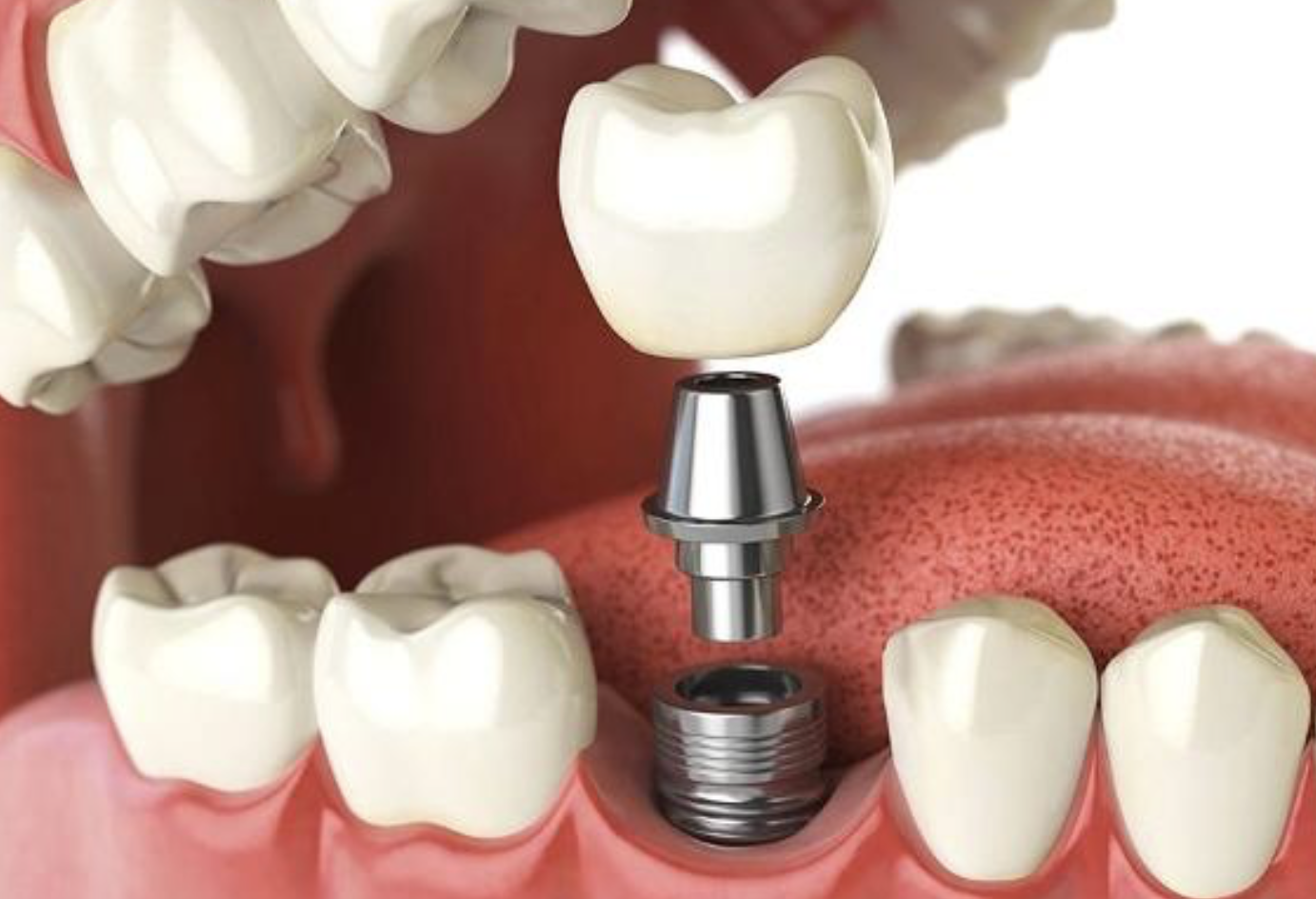 Implants Restoration